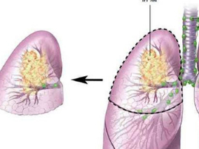 肺癌發(fā)現(xiàn)時已是晚期