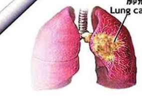 肺癌晚期还有救吗？