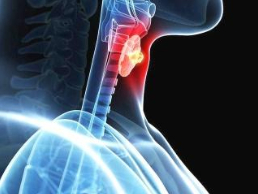喉癌早期有哪些症状？