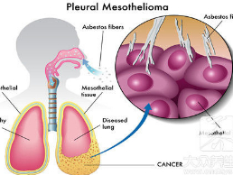 惡性胸膜間皮瘤