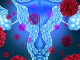 宫颈癌的5大致病因，值得女性反思！