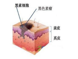 黑色素瘤早期癥狀 三大表現(xiàn)是黑色素瘤預(yù)警