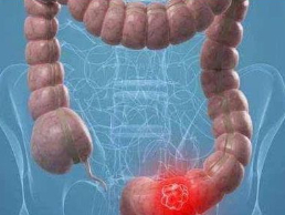 腸炎與腸癌最明顯區(qū)別在這里