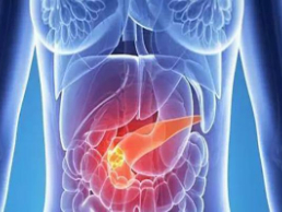 什么因素容易诱发胰腺癌？如何预防胰腺癌？